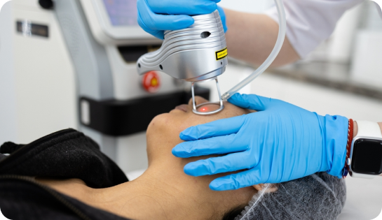 Best Microneedling Treatment in Islamabad