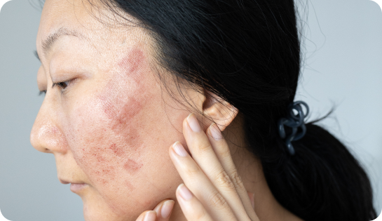 Best Microneedling Treatment in Islamabad